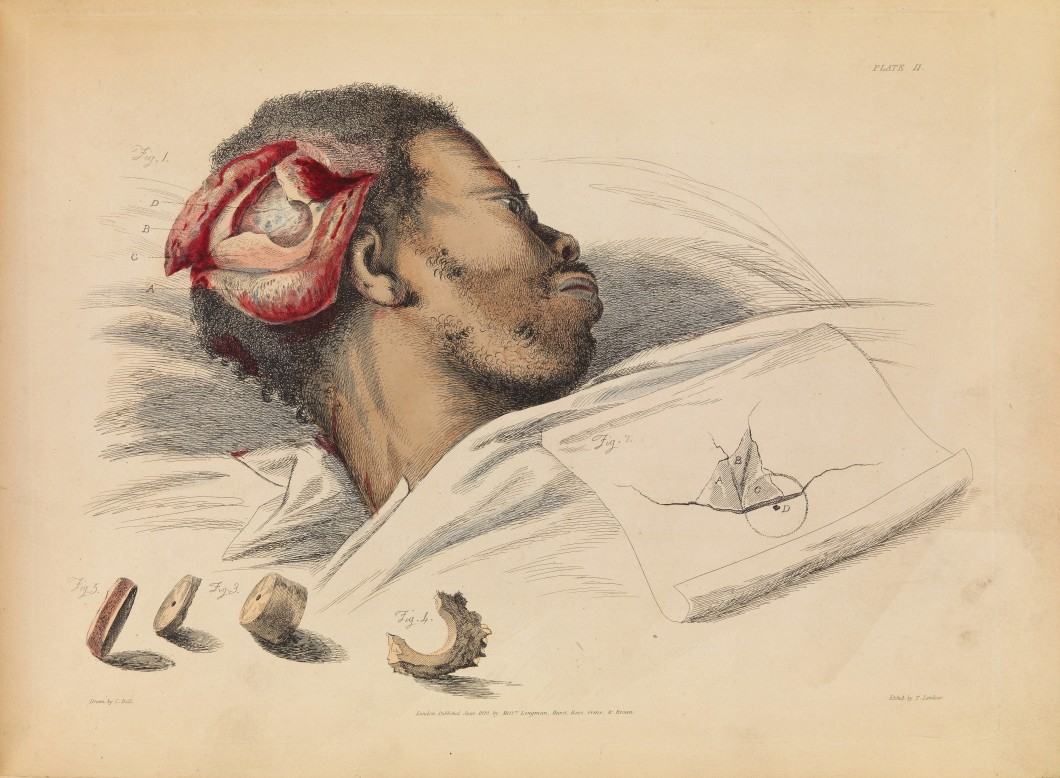 Illustrations of the Great Operations of Surgery, Trepan, Hernia, Amputation, Aneurism, and Lithotomy