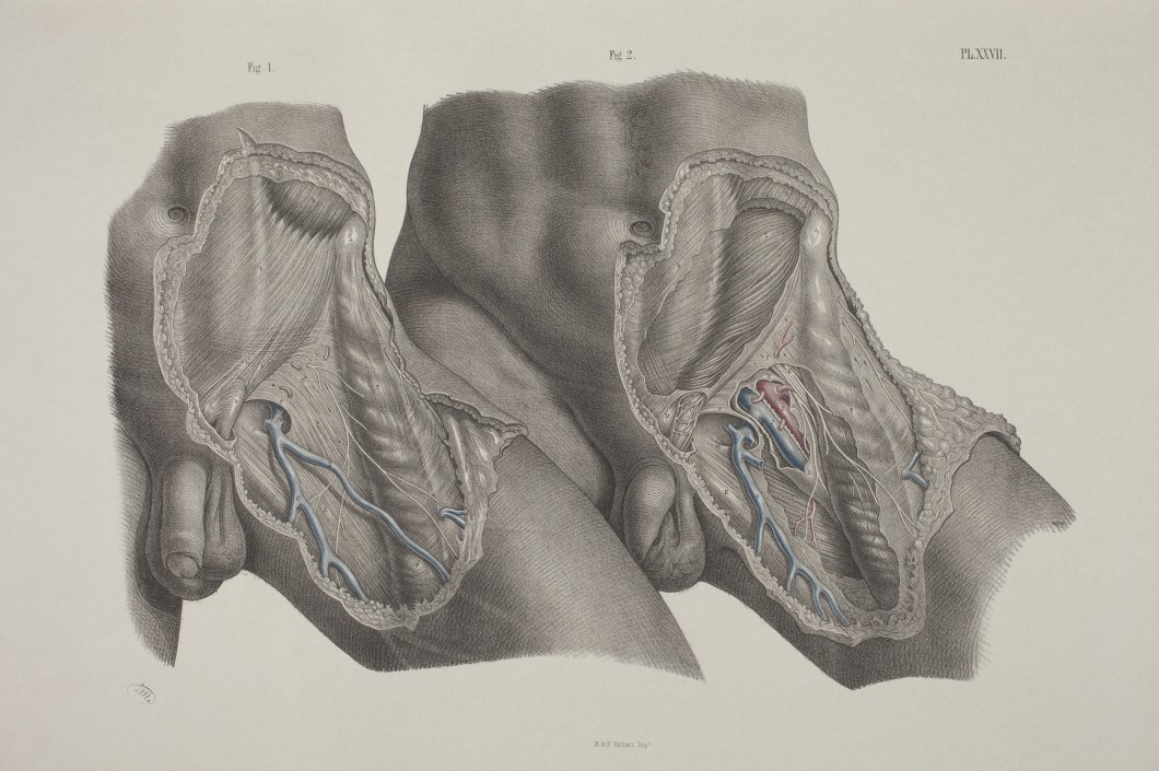 The Surgical Dissection of the Superficial and Deep Structures of the Inguino-Femoral Region, Hernial Protrusions are Very Liable to Occur at the Groin