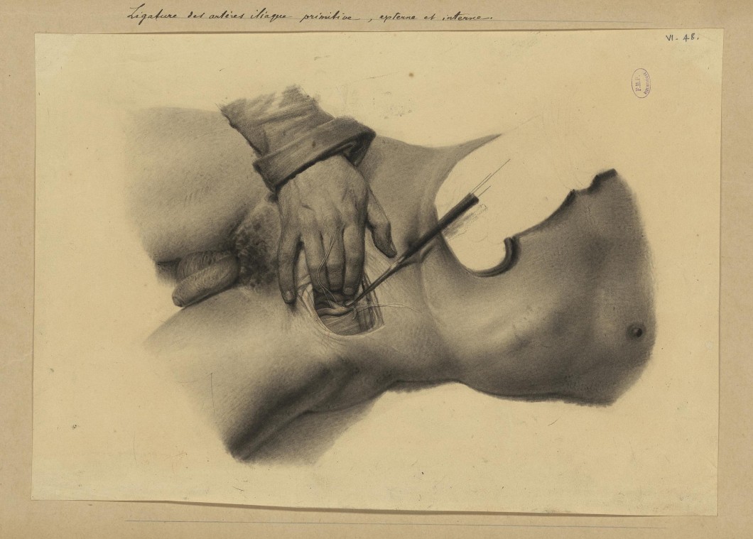 Study for Ligature des arteres iliaque primitive, externe et interne